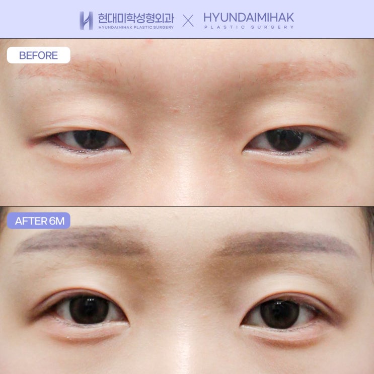 切开眼型矫正手术 让睁眼更轻松