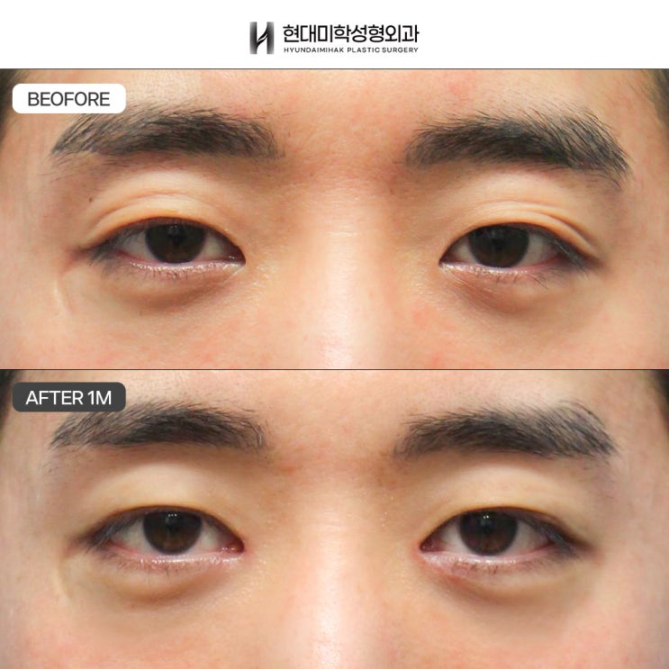 男士眼睑下垂矫正案例 如果想要明显的术前术后变化