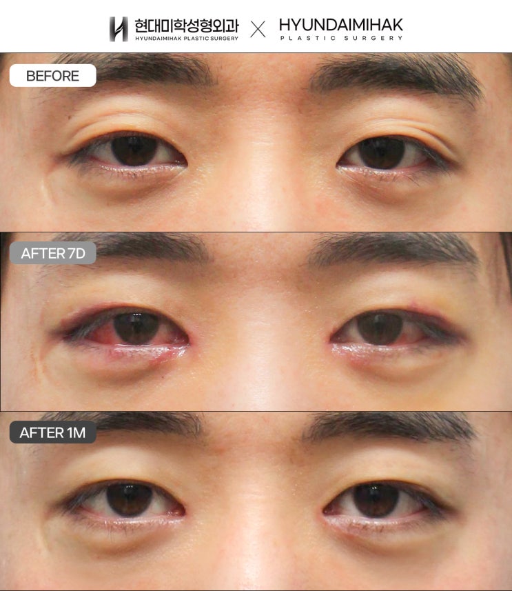 男士单眼皮眼神矫正,改变困倦印象