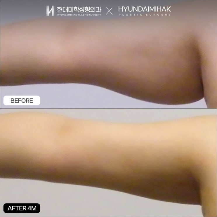 如何在合理的吸脂价格下获得理想效果