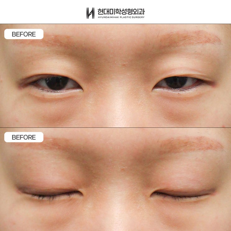 擅长眼肌矫正的医院:如何改善下垂眼型