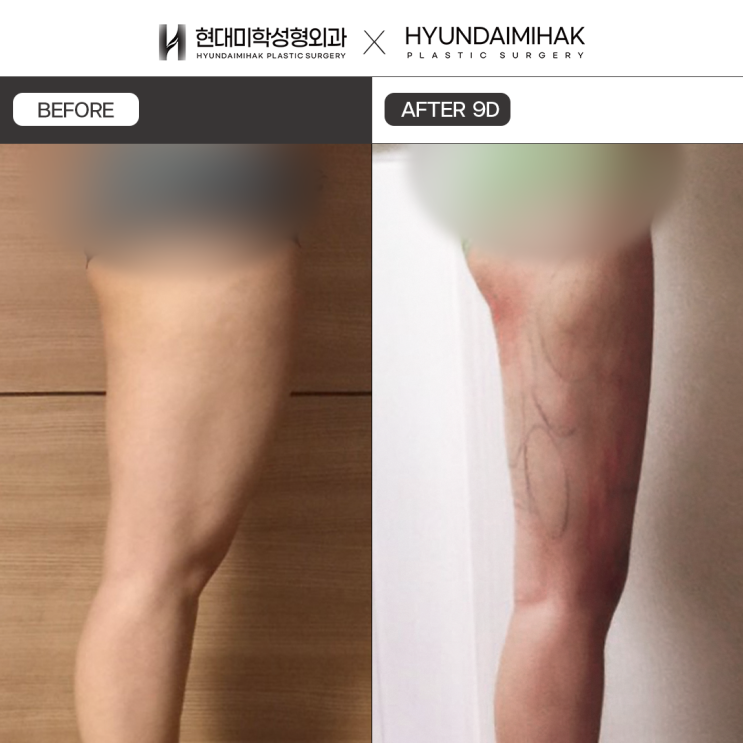 迷你吸脂:仅一天终结烦恼,轻松打造理想身体线条的方法