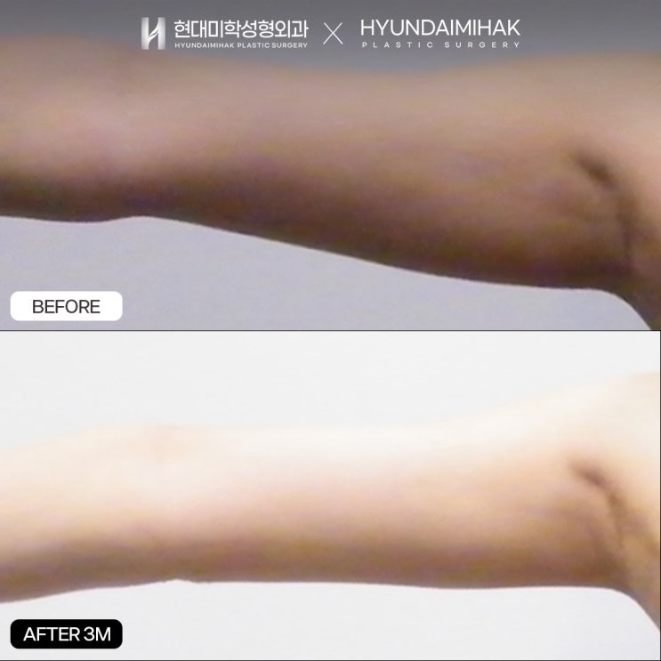 手臂吸脂手术:快速塑造纤细手臂线条的方法