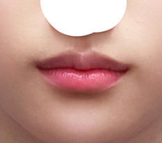 I am satisfied with my lip surgery haha