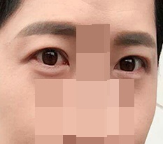 男生双眼皮手术评价 ㅋㅋㅋ
