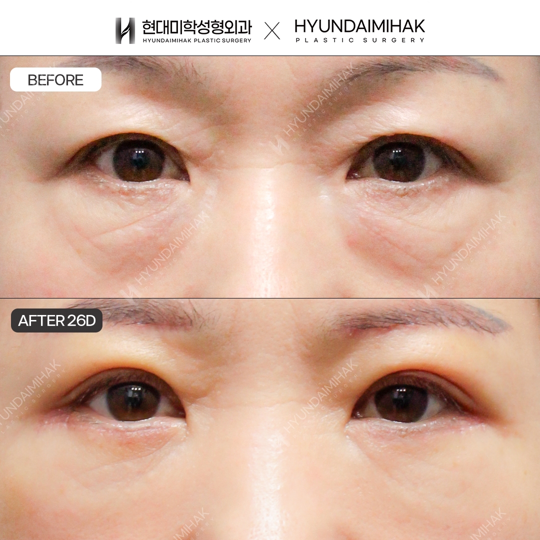 [中年眼部整形] 上眼睑 + 下眼睑 + 眼下脂肪重置