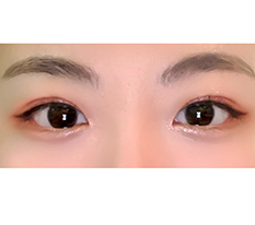 第一次眼部整形成功了