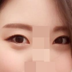 完美大眼加做开眼角！