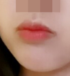 做完嘴角整形后成了受欢迎女生哈哈哈