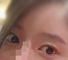 眼型矫正非常满意！