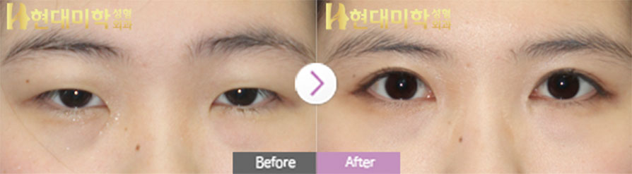切开法、眼型矫正、开内眼角