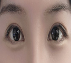 埋线双眼皮松了，找黄浩院长做了切开双眼皮修复