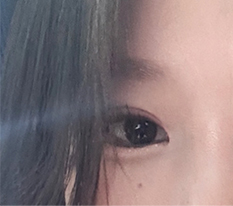 Double eyelid surgery is the answer for uneven eyes haha