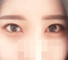 我做了外眼角和下眼睑下至!!!!