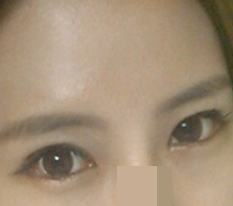 This is my eye surgery review