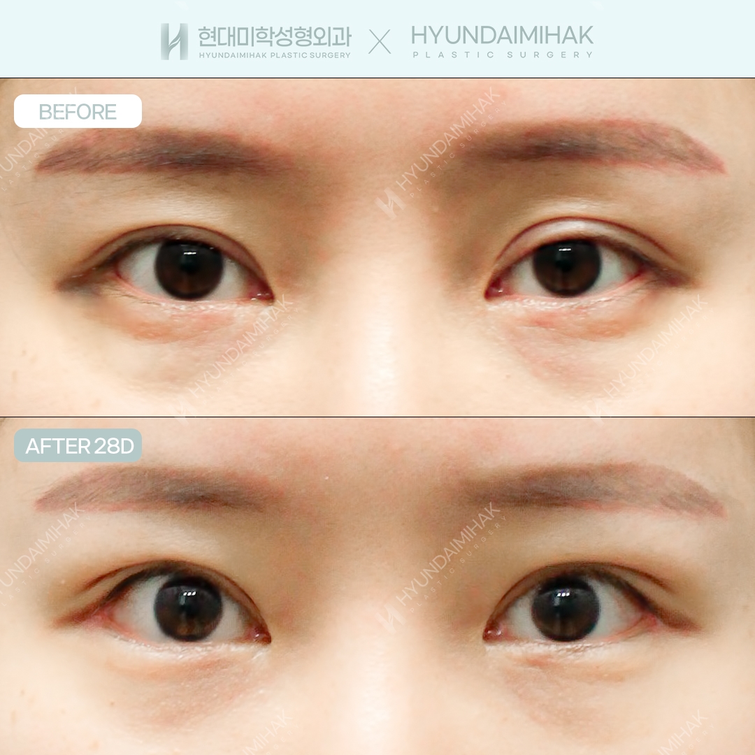 [眼部修复手术] 切开眼形矫正 + 双重开眼角