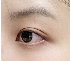 双眼皮两个月后记 ㅎㅎ 怎么样??