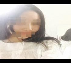 纠结后做的鼻整形感想