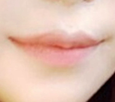 在洪院长那里做的嘴角手术~~~~