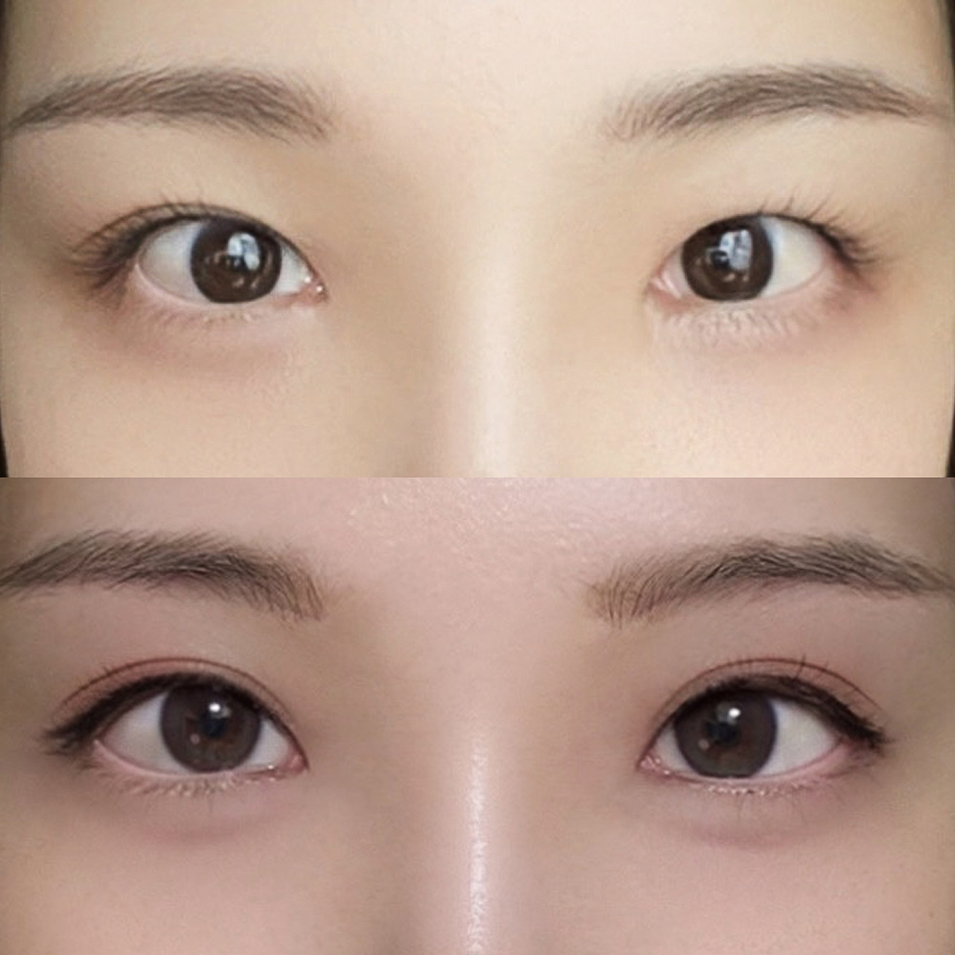 松开的眼修复：双眼皮修复+眼型矫正+后下开眼角