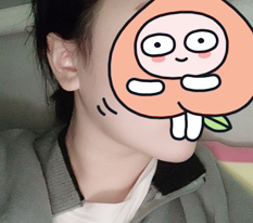 做面部吸脂后下巴肉没了