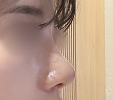 把驼峰鼻解决掉了