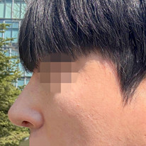 男士驼峰鼻整形