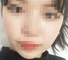 颧骨缩小