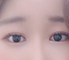 ♡三项眼部开大套餐♡