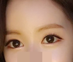 做了开眼角后变漂亮了