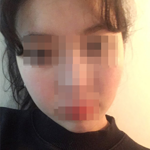 只做了颧骨手术而已