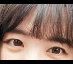 开眼角手术后感～*