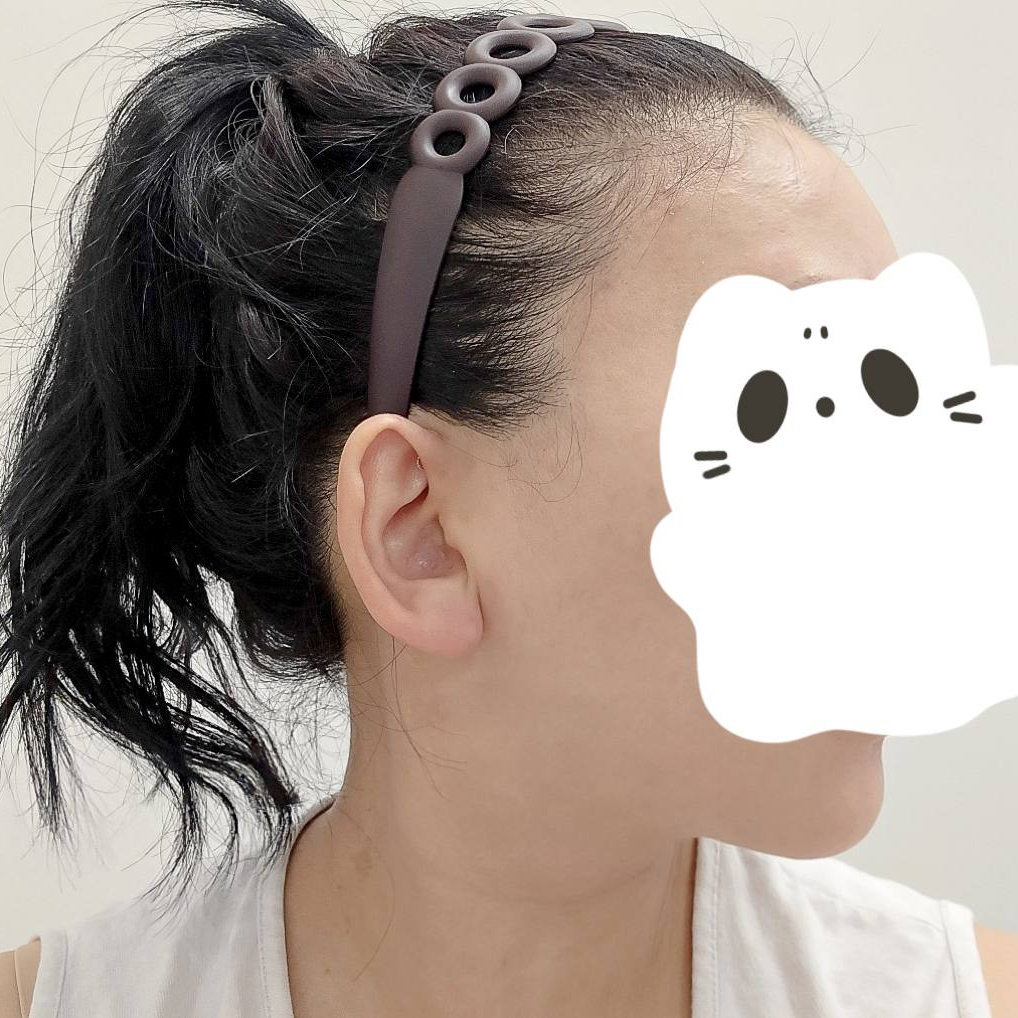 面部+双下巴吸脂传奇案例，正在了解面吸、下巴吸脂的人一定要看