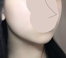线雕提升效果很棒
