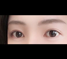 大小眼降线双眼皮修复
