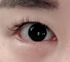 后眼角下至修复满意度10000%