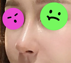 鼻子手术一个月了，超级满意^^