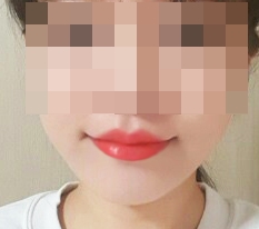 丘比特嘴角+唇珠