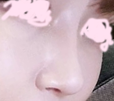 鼻修复手术 分享~