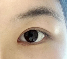 带着眼部整形评价来了 ^q^