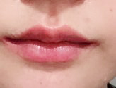 嘴角手术一个月 评价