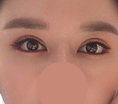 眼修复一个月啦 哈哈 这样算成功吧？？^^