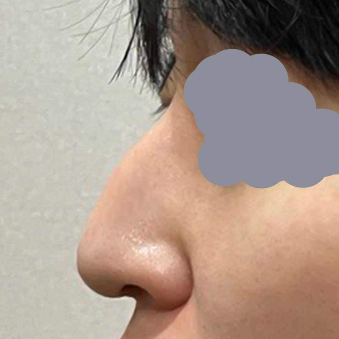 男性驼峰鼻手术