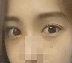 眼修复现在终于满意了！！！♡♥