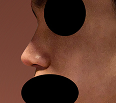 From a feminine nose to a masculine nose
