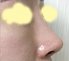 My upturned-nose surgery was a complete success ^^