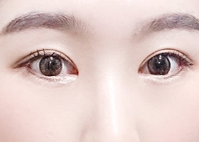 眼部整形就去现代美学吧~