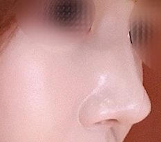 This was revision rhinoplasty, and this time I used autologous rib cartilage