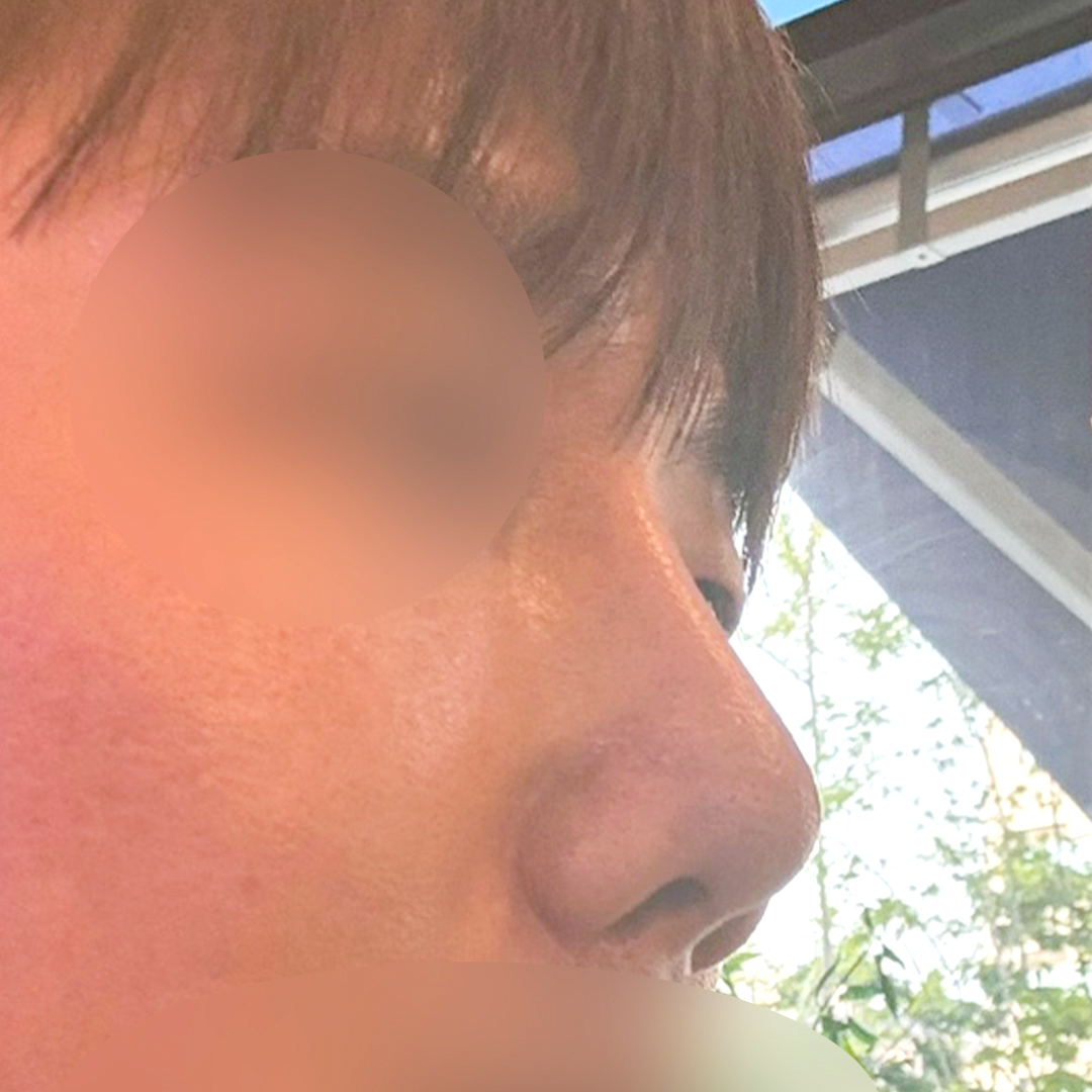 Male nose surgery, 1 month