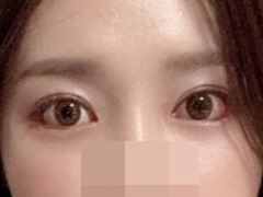 做了眼部手术~♥